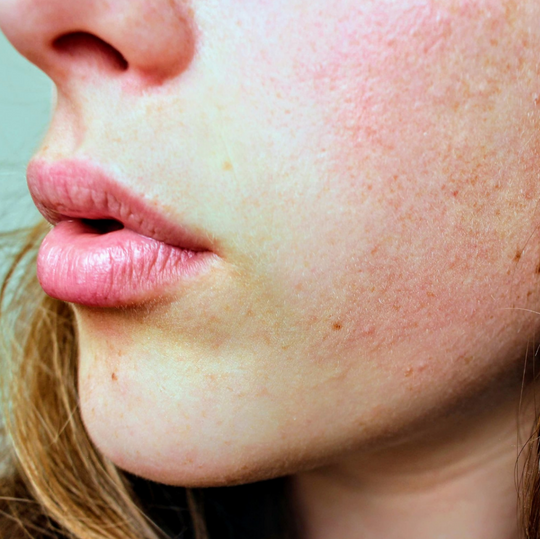 Pilaris Keratosis