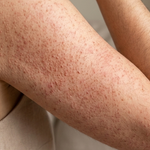 Close-up of keratosis pilaris rough bumpy texture on upper arm — skin concern targeted by Sealuxe exfoliating body scrub