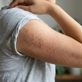 Close-up of keratosis pilaris rough bumpy texture on upper arm — before using Sealuxe exfoliating body scrub