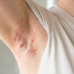 Close-up of razor burn and ingrown hairs on underarm skin — skin concern addressed by Sealuxe natural shaving soap
